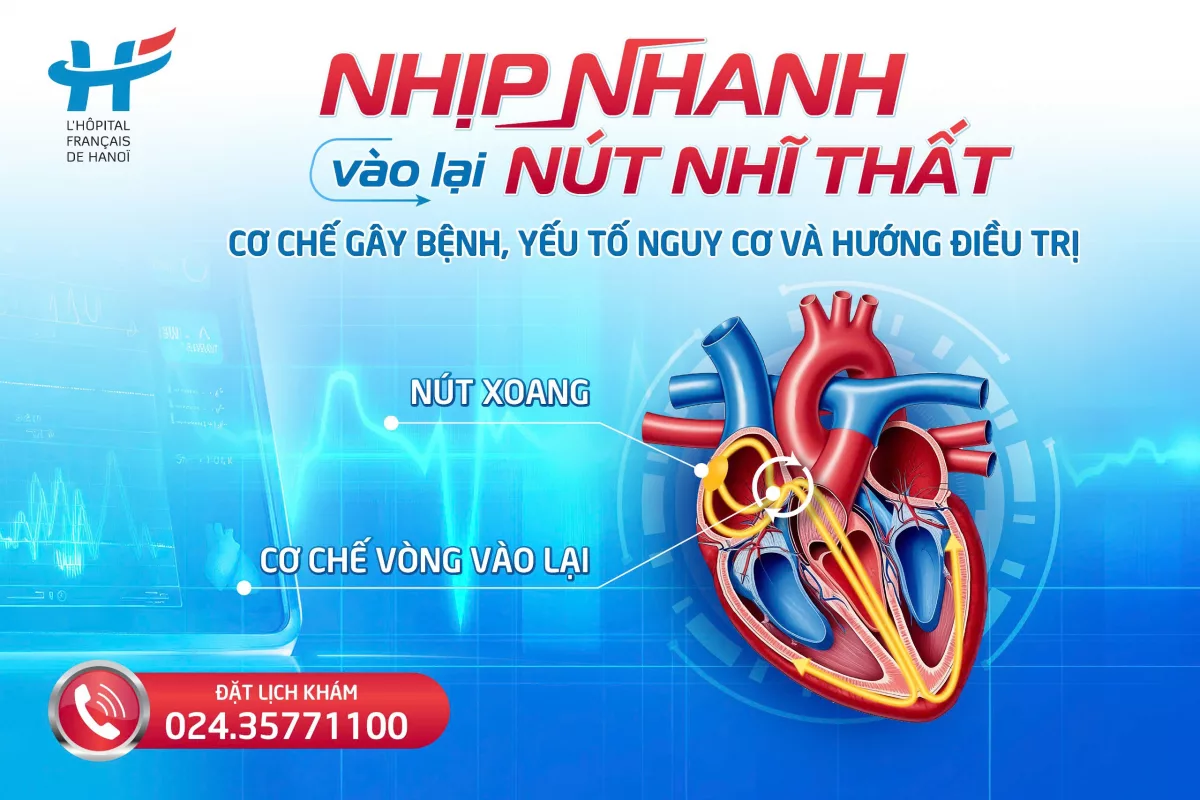 Nhịp nhanh vào lại nút nhĩ thất: Nguyên nhân, triệu chứng và cách điều trị